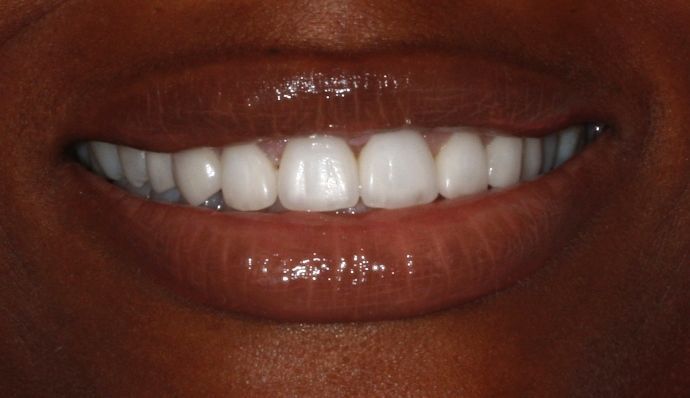 After veneers