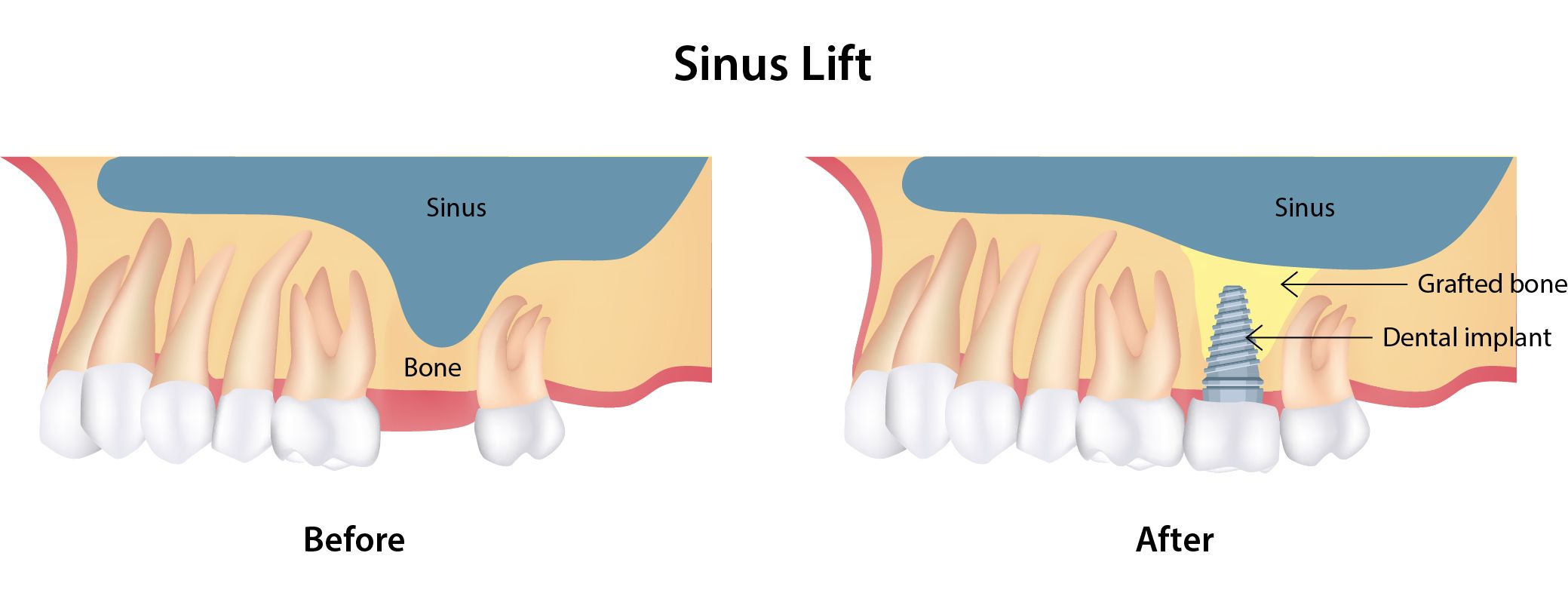 illustration of sinus lift before and after